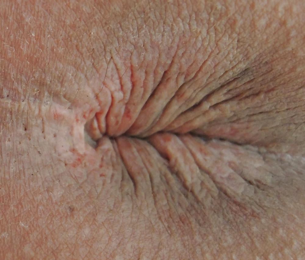 25P Amandas butthole march 2013