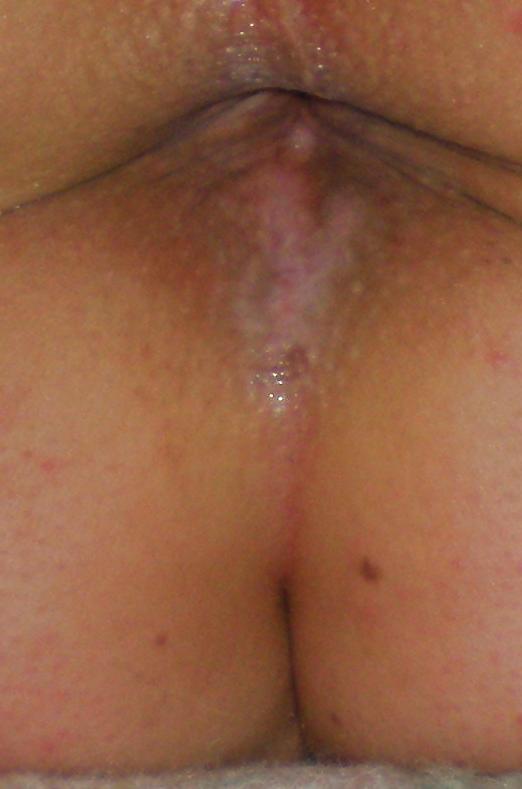 22P My nude teenage girlie butthole