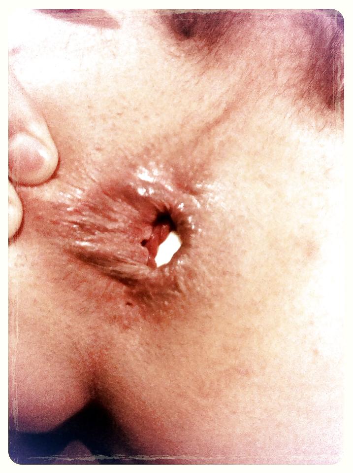 16P My asshole