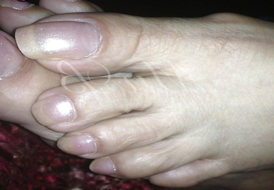 18P Long toenails