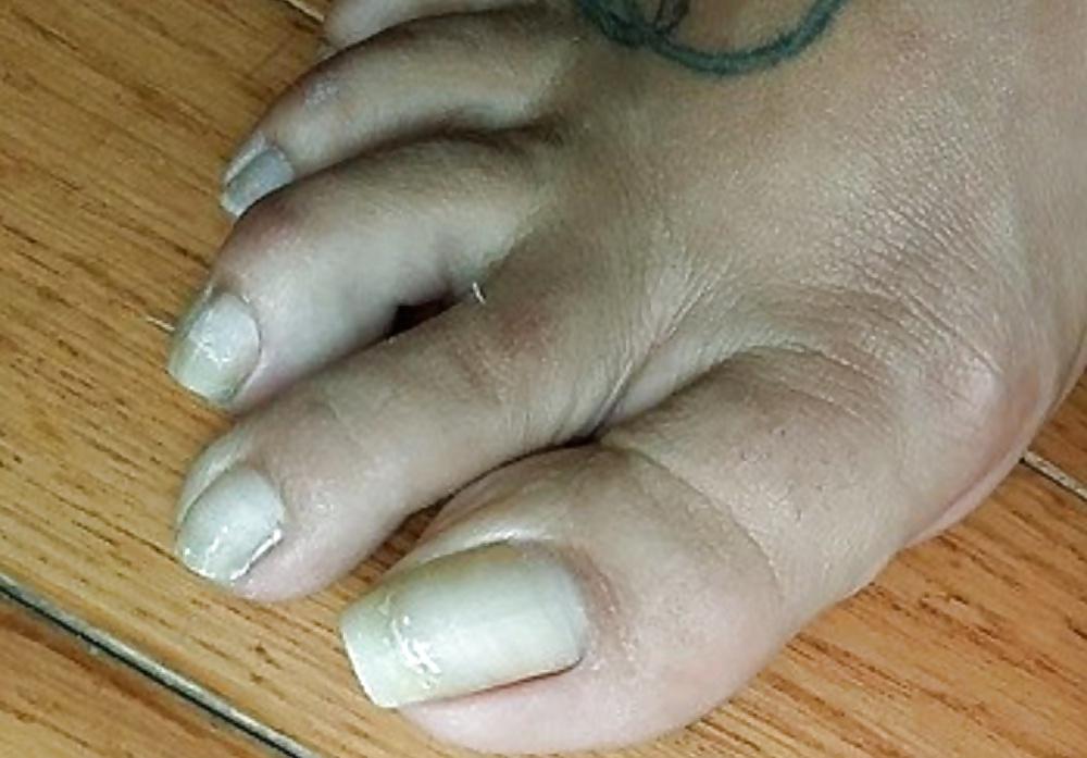18P Long toenails