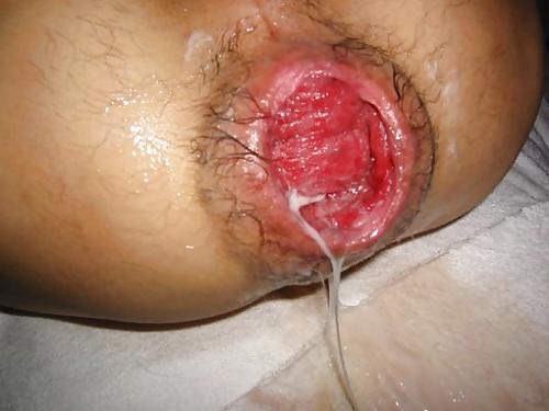 9P Asshole anal extreme rosebud gape prolaps 