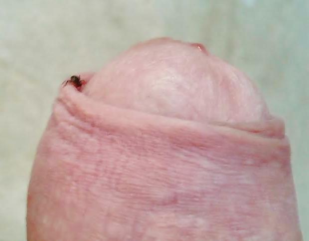20P Ants on my penis