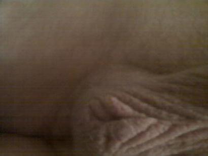 25P Hermaphrodite