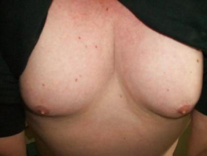25P Hermaphrodite