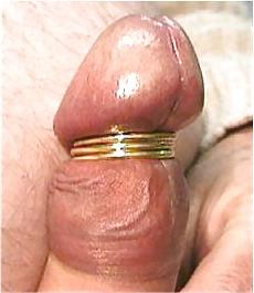 24P Penis with meatotomy and frenulotomy