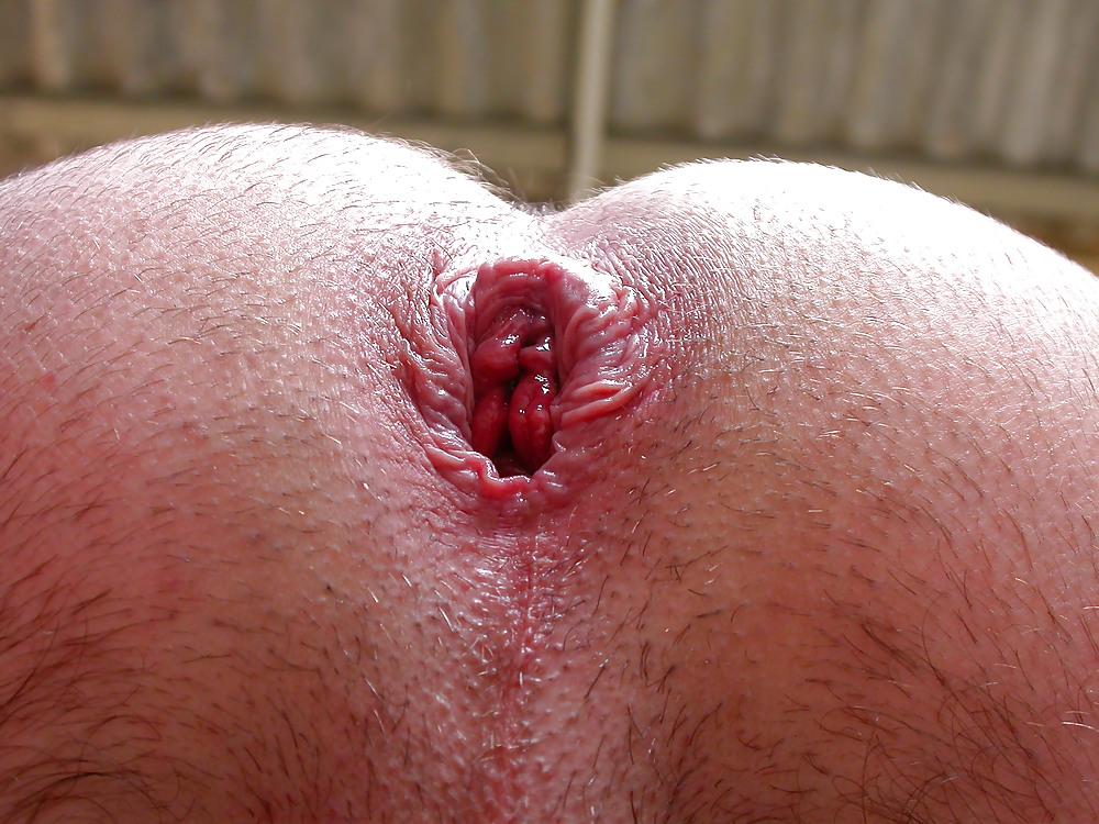 12P Asshole prolapse