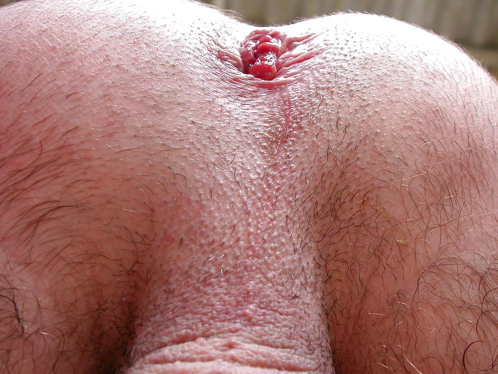 12P Asshole prolapse