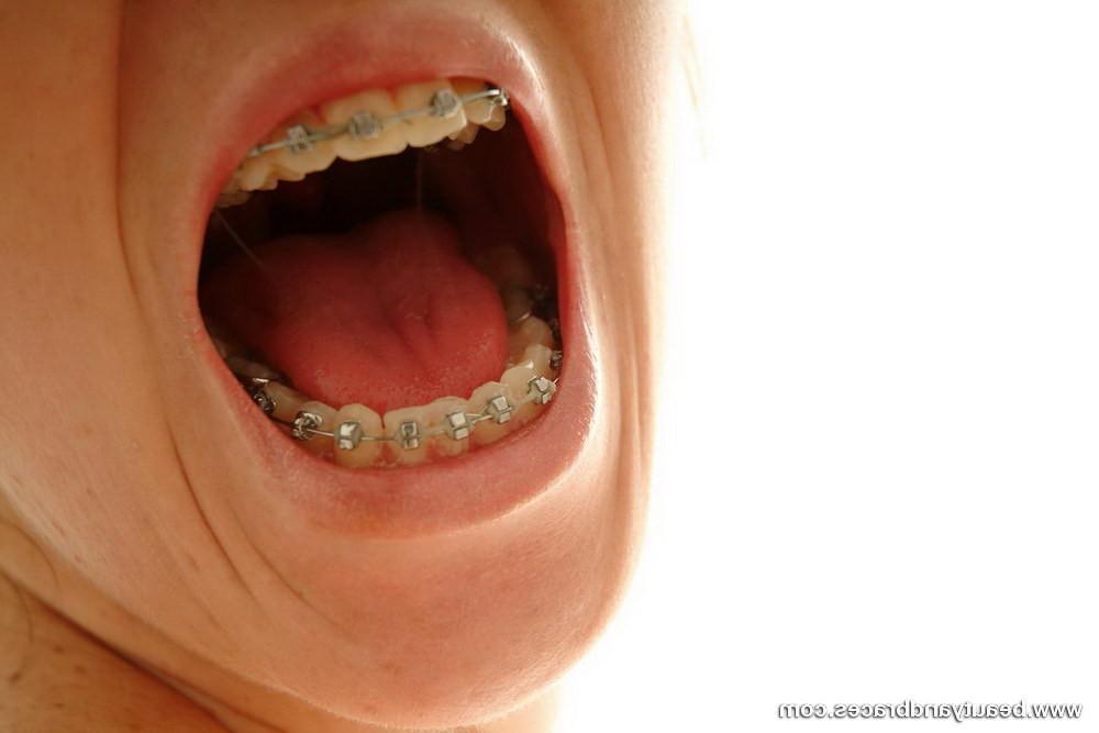 16P Cute minx spreads her cock hungry mouth open to show sexy braces
