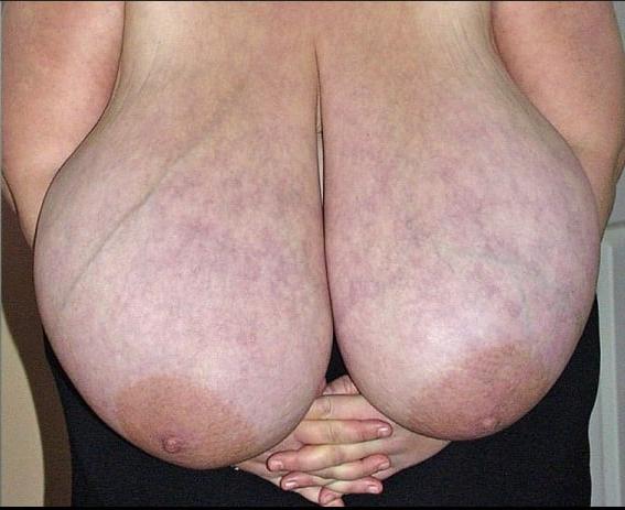 25P Macromastia Monster Tits