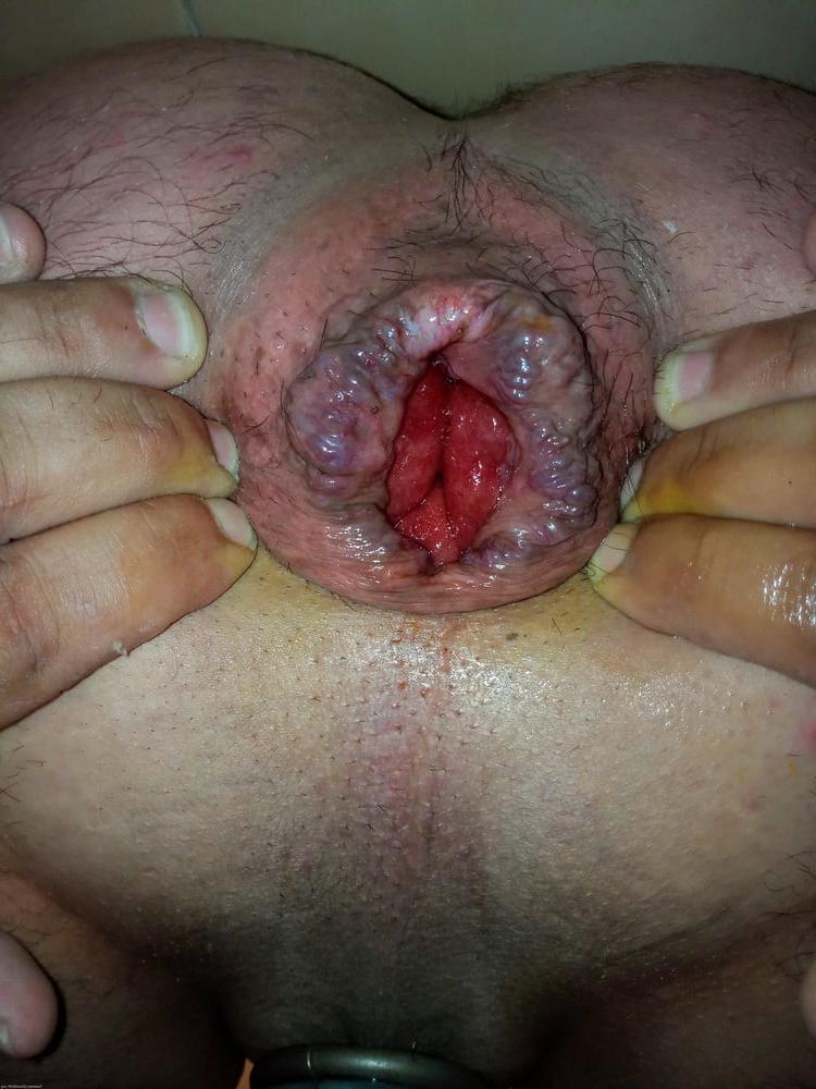 25P My asshole in different stages