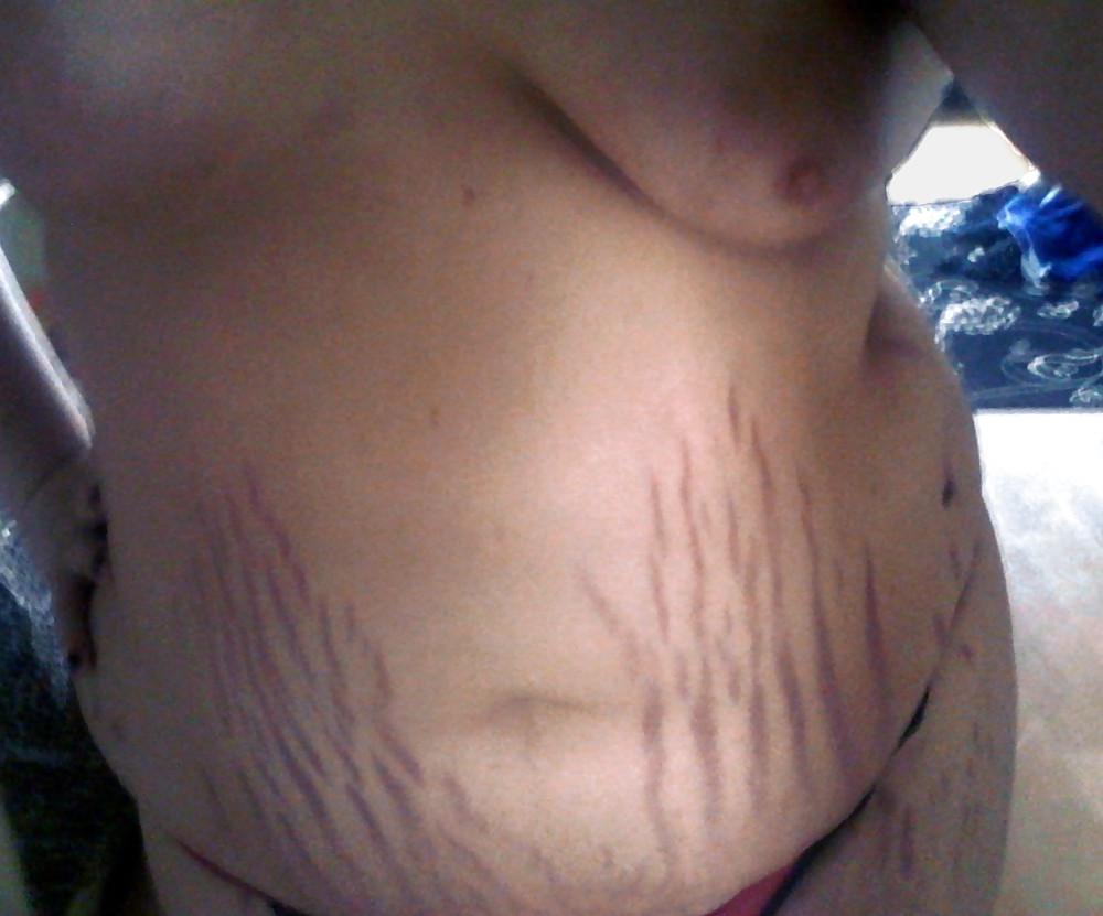 25P Show me your stretch marks