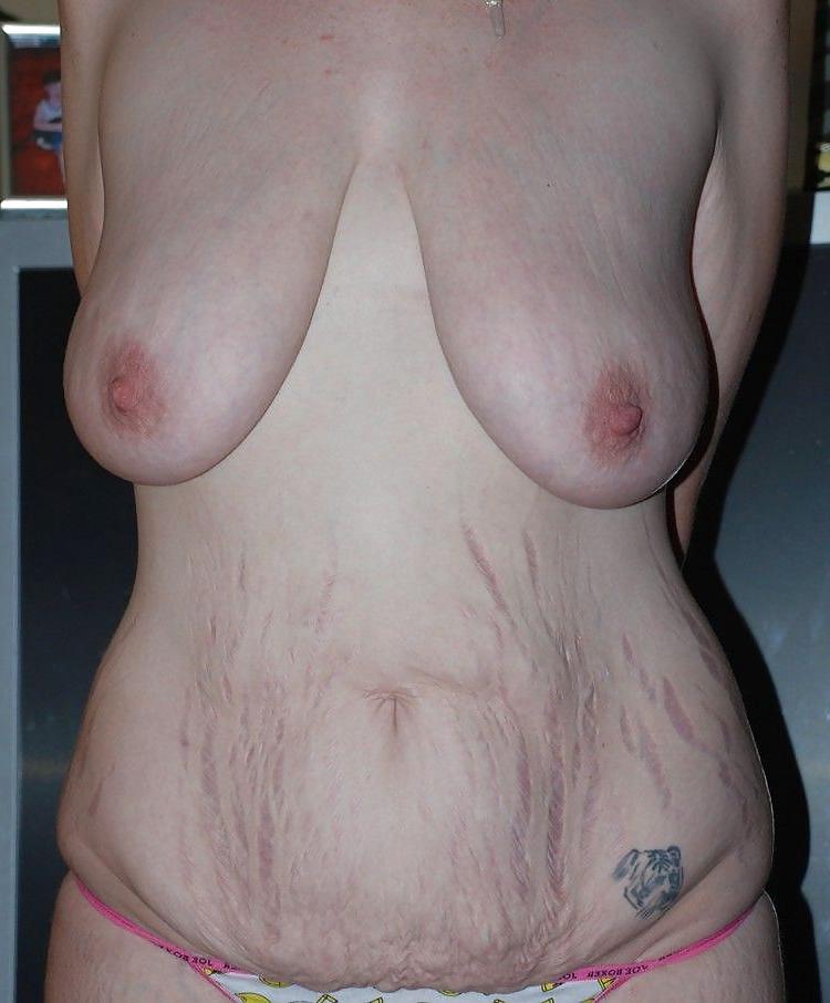 25P Show me your stretch marks