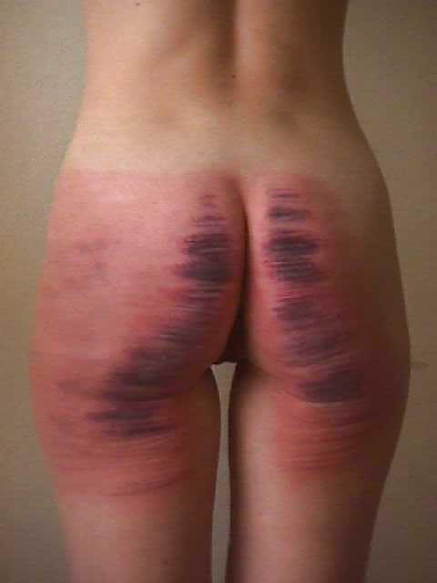 13P CANING STRIPES