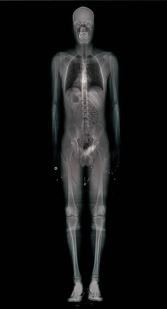 19P Sex under mri or xray