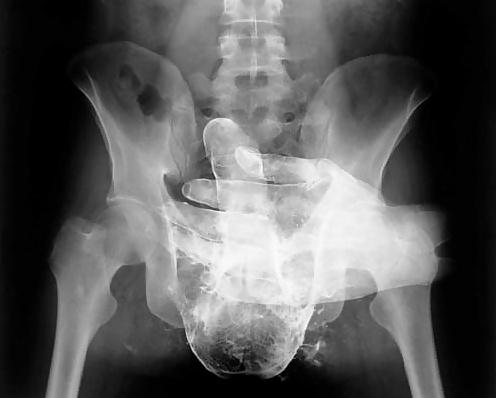 19P Sex under mri or xray