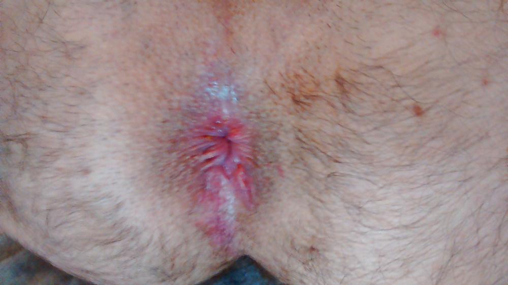 4P Gaping my asshole with my huge dildo!