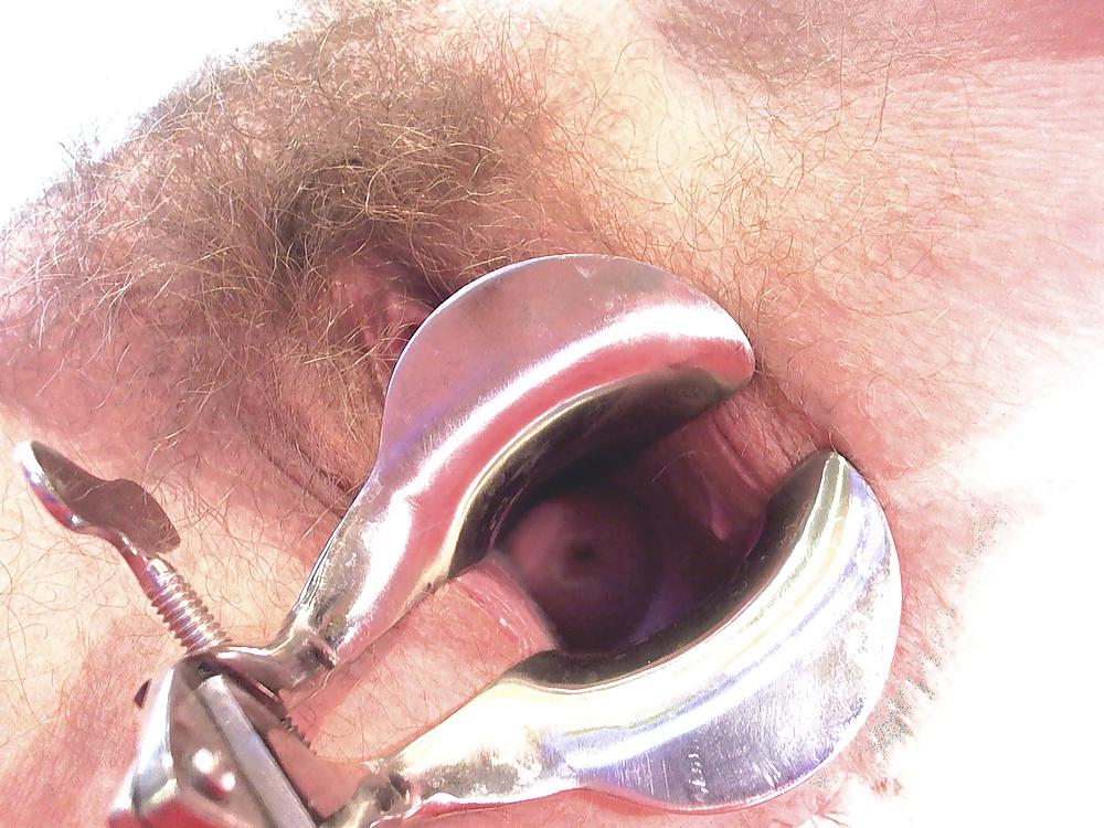25P Amatrice qui fait des cam s'ecarte au speculum