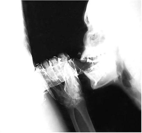 12P X-Ray