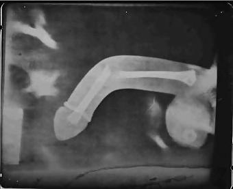12P X-Ray