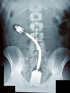 12P X-Ray