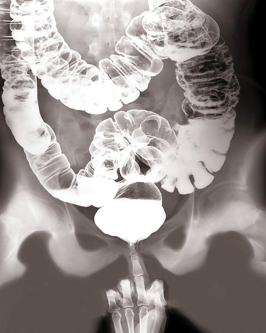 12P X-Ray