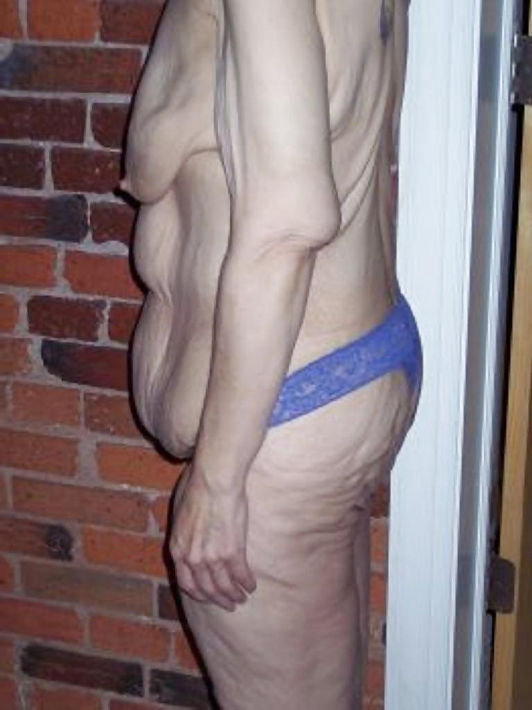 25P Elderly vulva over 60