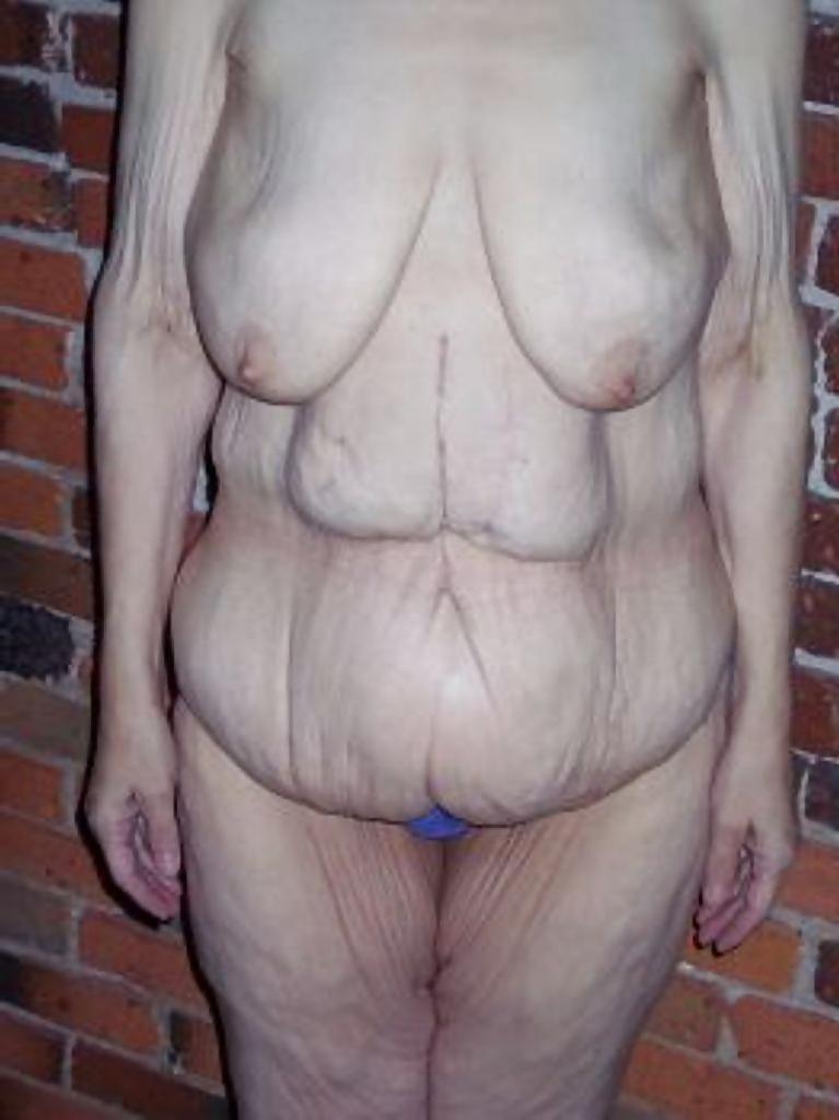 25P Elderly vulva over 60