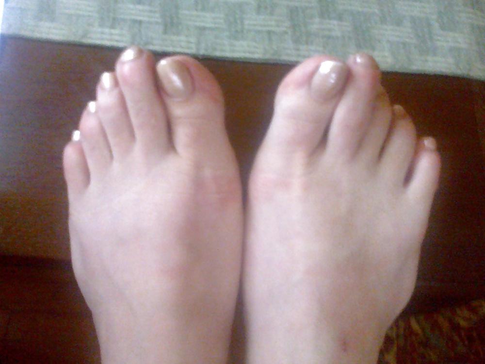 25P Toenails