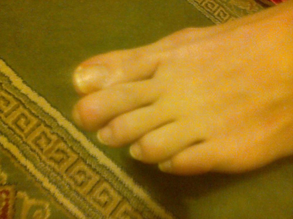 25P Toenails