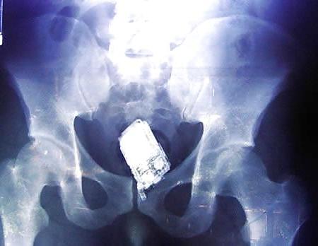 15P X-ray