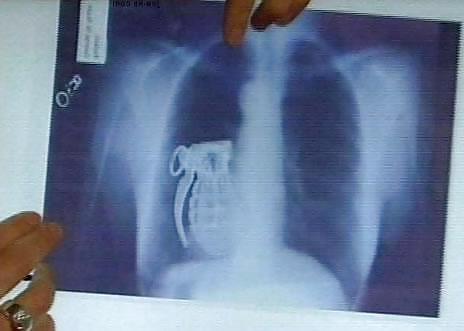 15P X-ray