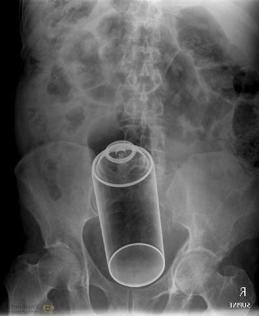 15P X-ray