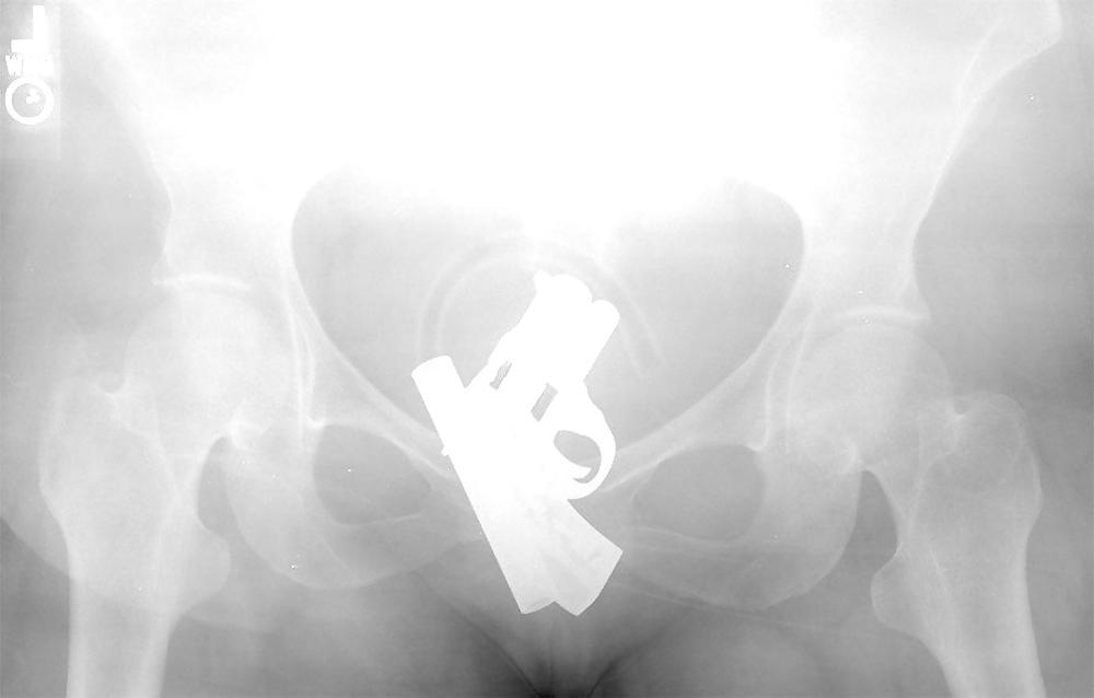 15P X-ray