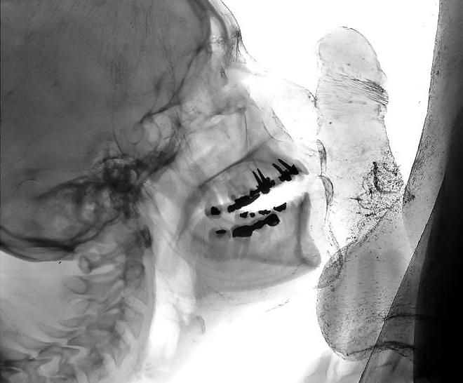 15P X-ray