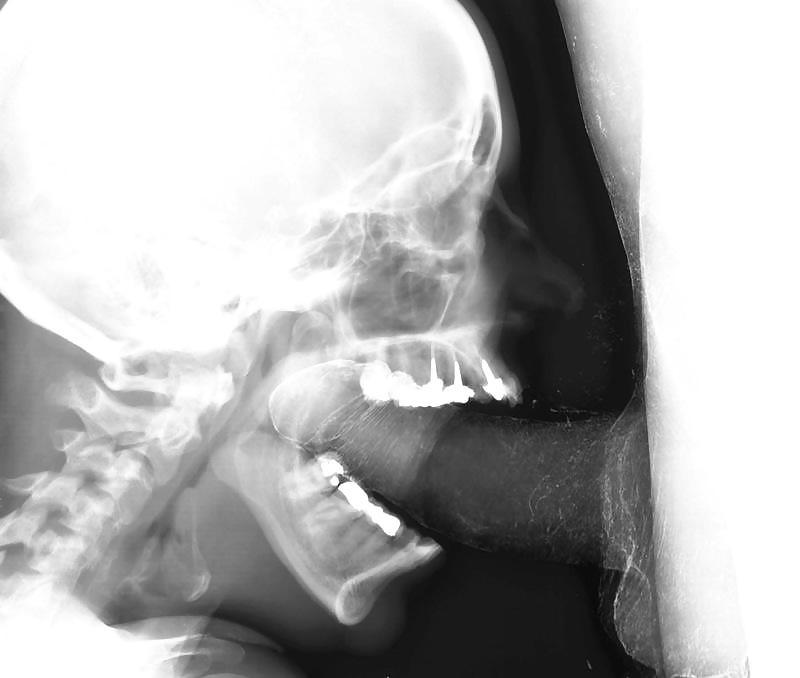15P X-ray