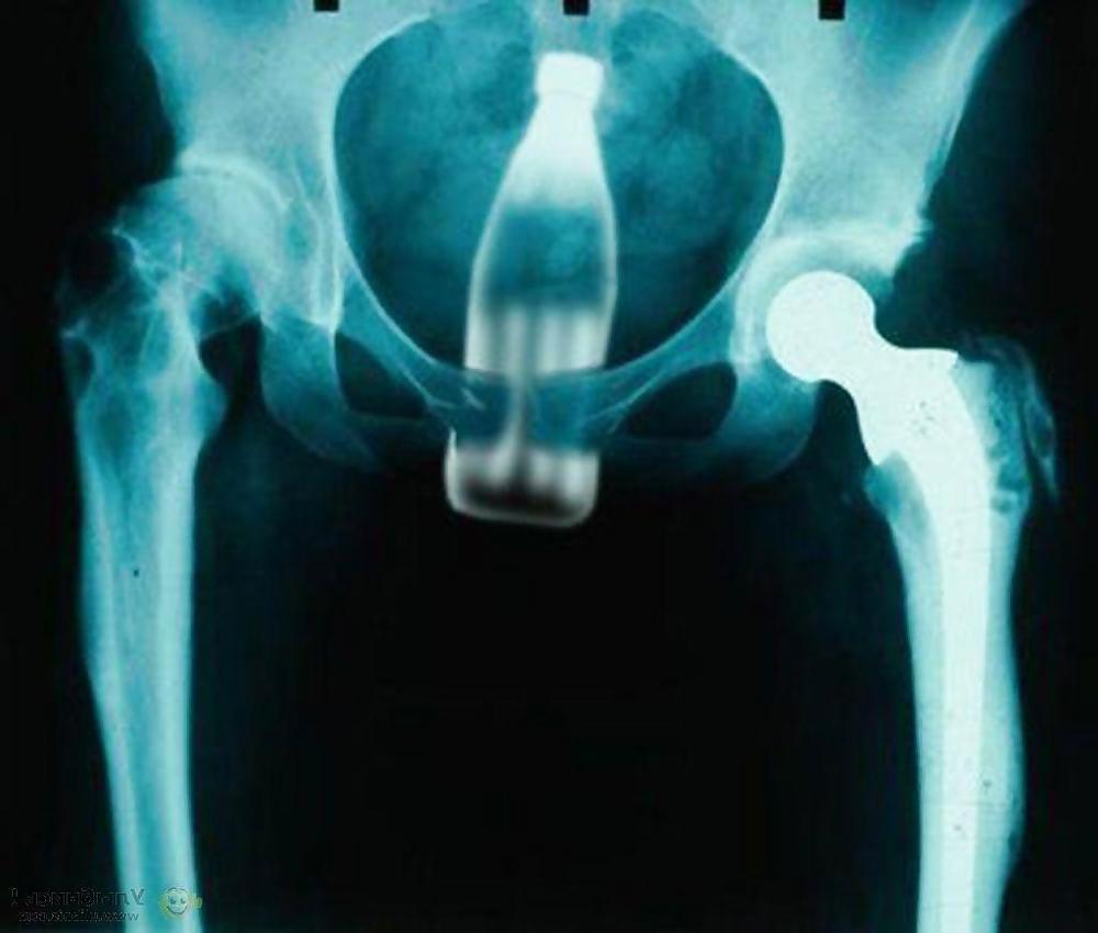 15P X-ray