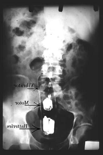 15P X-ray