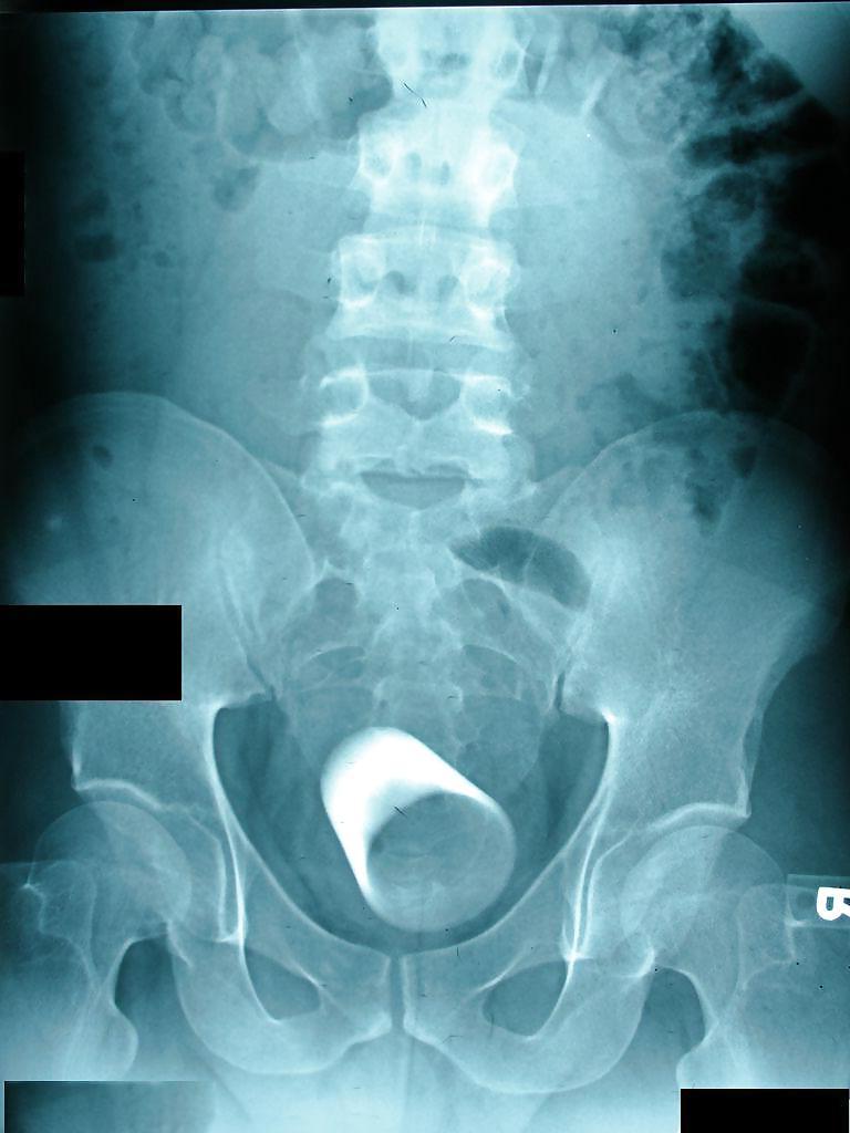 15P X-ray