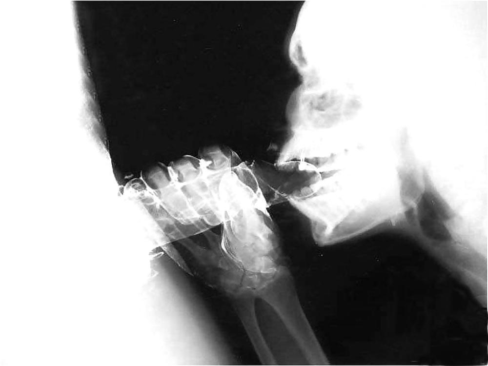 15P X-ray
