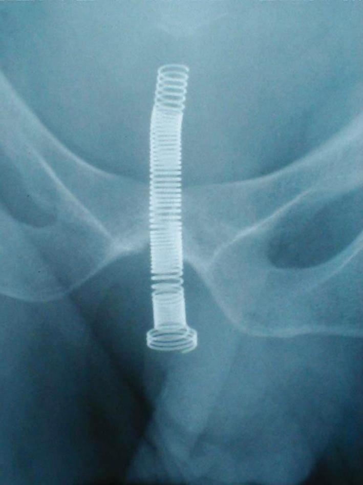 15P X-ray