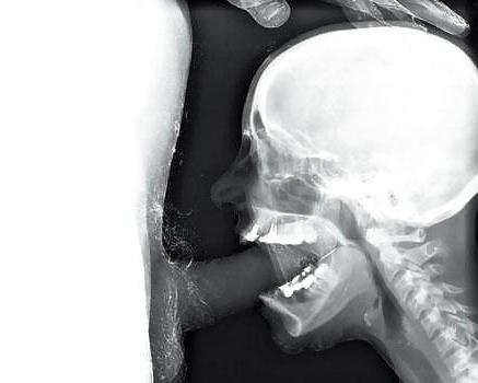 15P X-ray