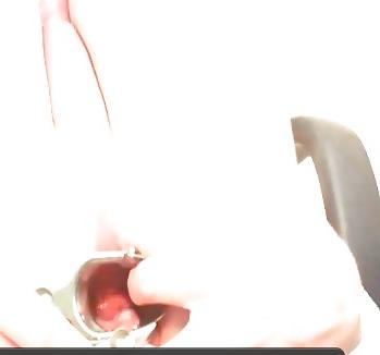 12P Gaping hole