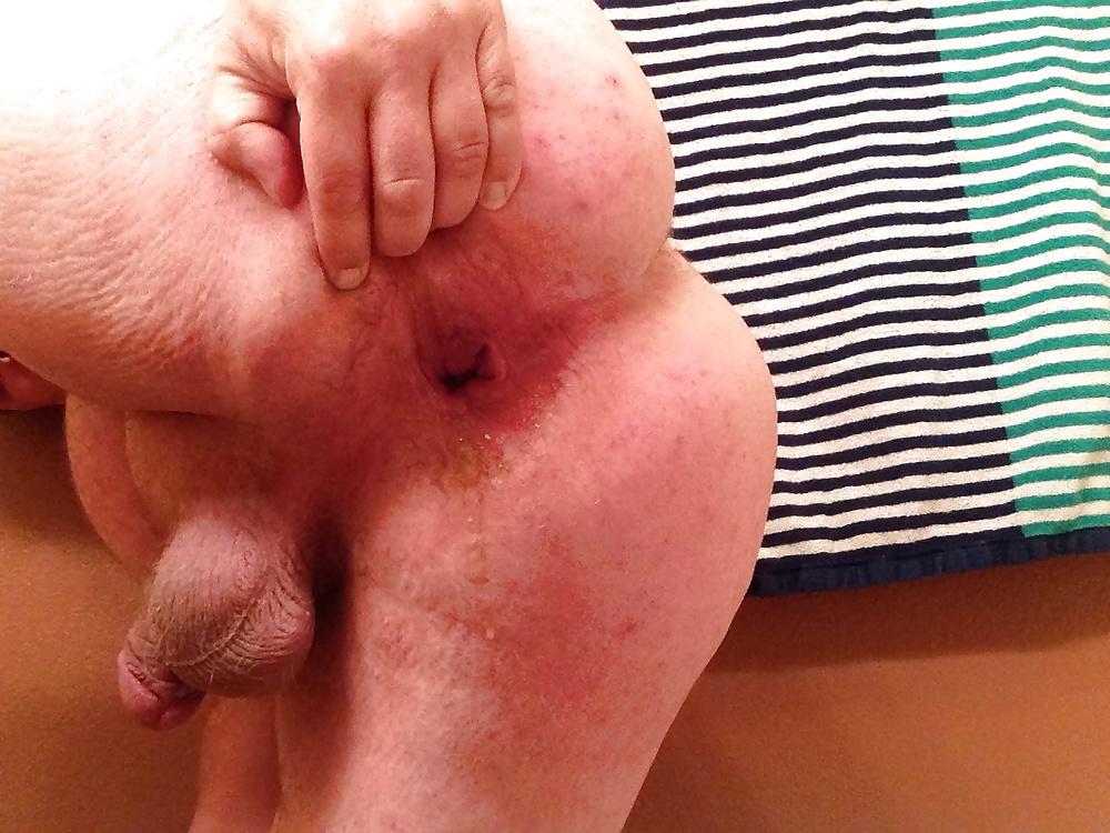 20P Gaping My Ass Hole