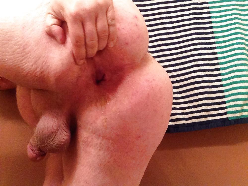 20P Gaping My Ass Hole