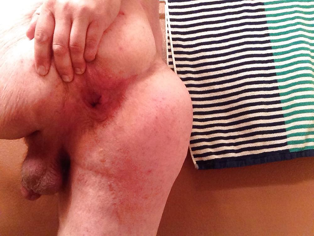 20P Gaping My Ass Hole