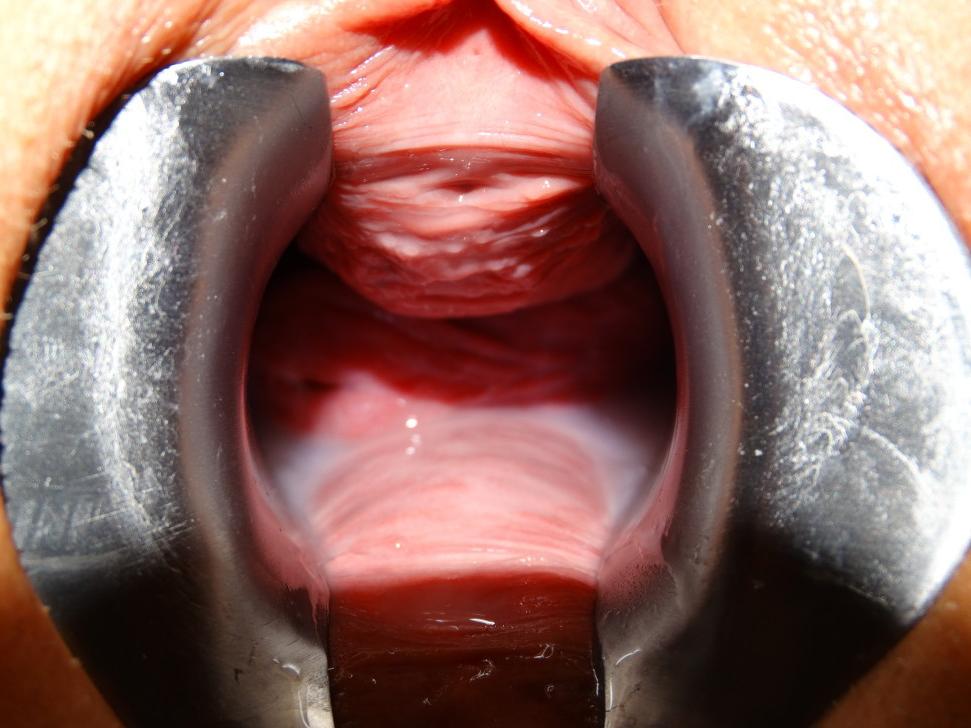 17P Extreme speculum exam