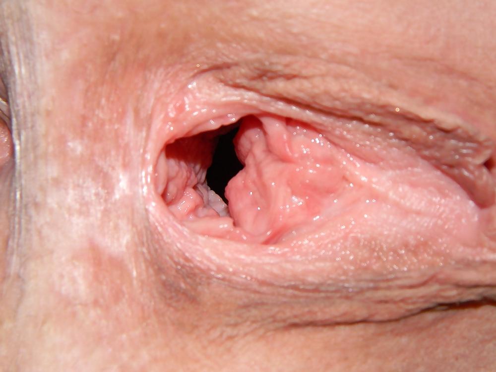 25P GAPE